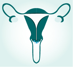 About cervical cancer