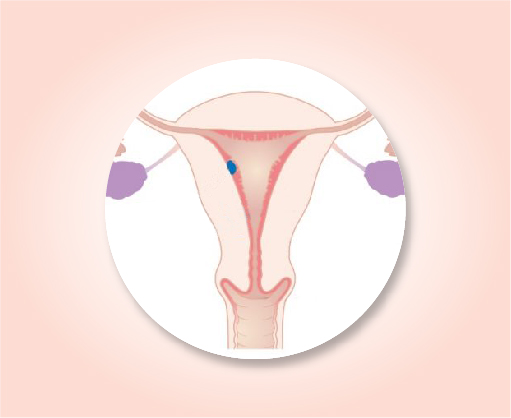 About uterine cancer