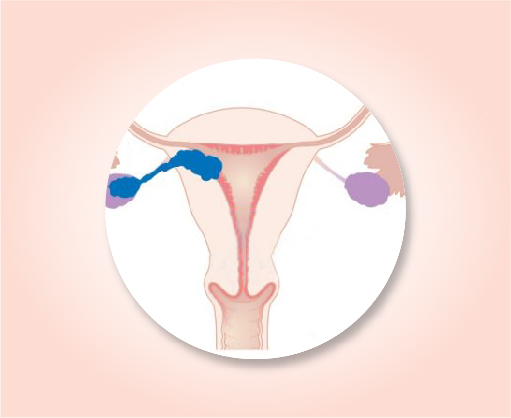 About uterine cancer