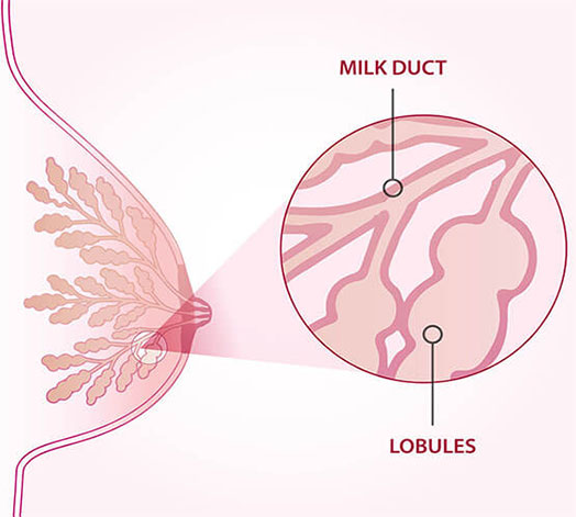 Breast Lumps: Clogged Milk Duct or Cancer?